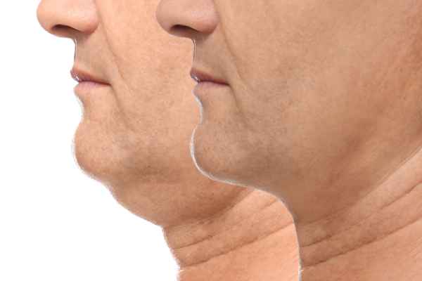 HIFU - Breakthrough in Anti - ageing 2 hifu results Leeds