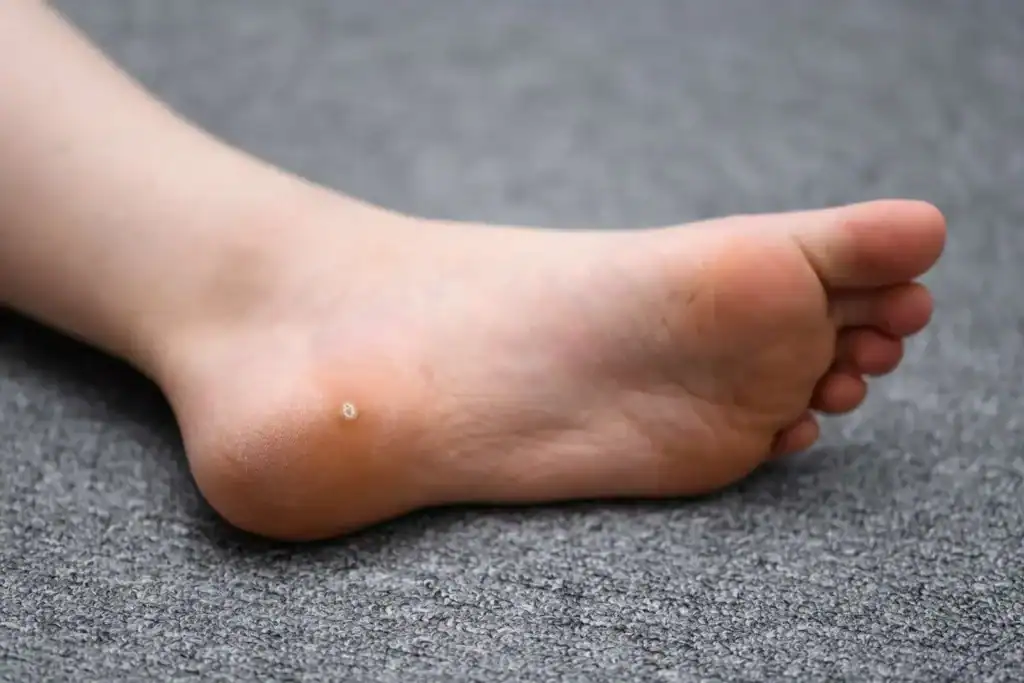Cryotherapy For Warts And Also Verrucas 2 Image of verruca on the bottom of the foot that able to be treated with Cryotherapy Leeds