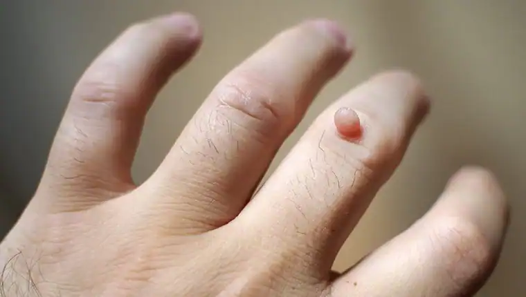 Cryotherapy For Warts And Also Verrucas 1 Image of blemish that Cryotherapy Leeds can remove with Lipo 360.