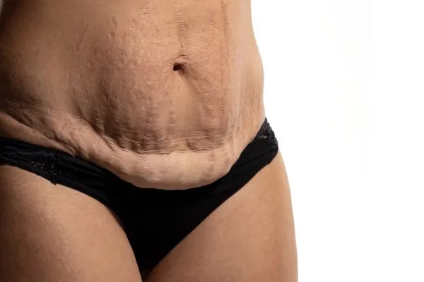 The Science of Skin Tightening 1 The science behind skin tightening Leeds picture of a woman's sagging skin on the stomach